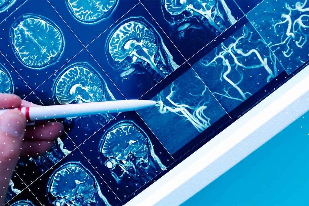 Investigación chilena promete detectar antes el Alzheimer